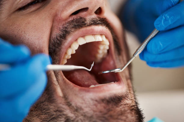 Best Emergency Treatment for Dental Infections or Abscesses in South Hill, NY